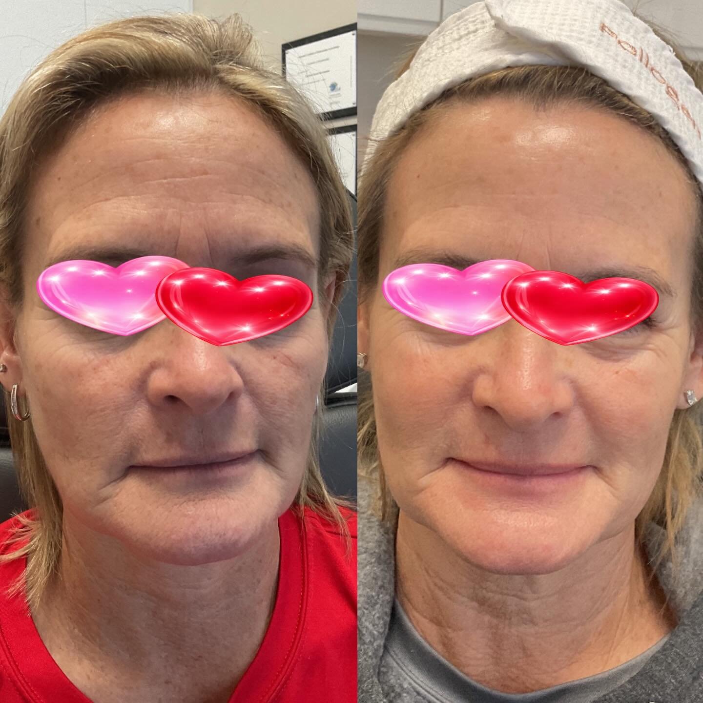 This week is the time to revive your skin for Valentine&rsquo;s Day with a VI Precision Plus Peptides Peel. We have a limited number of VI Skin Brightening Systems to set you up for your best long-term result!❤️ #vipeel🍃  #peptides #bestskin #bestae