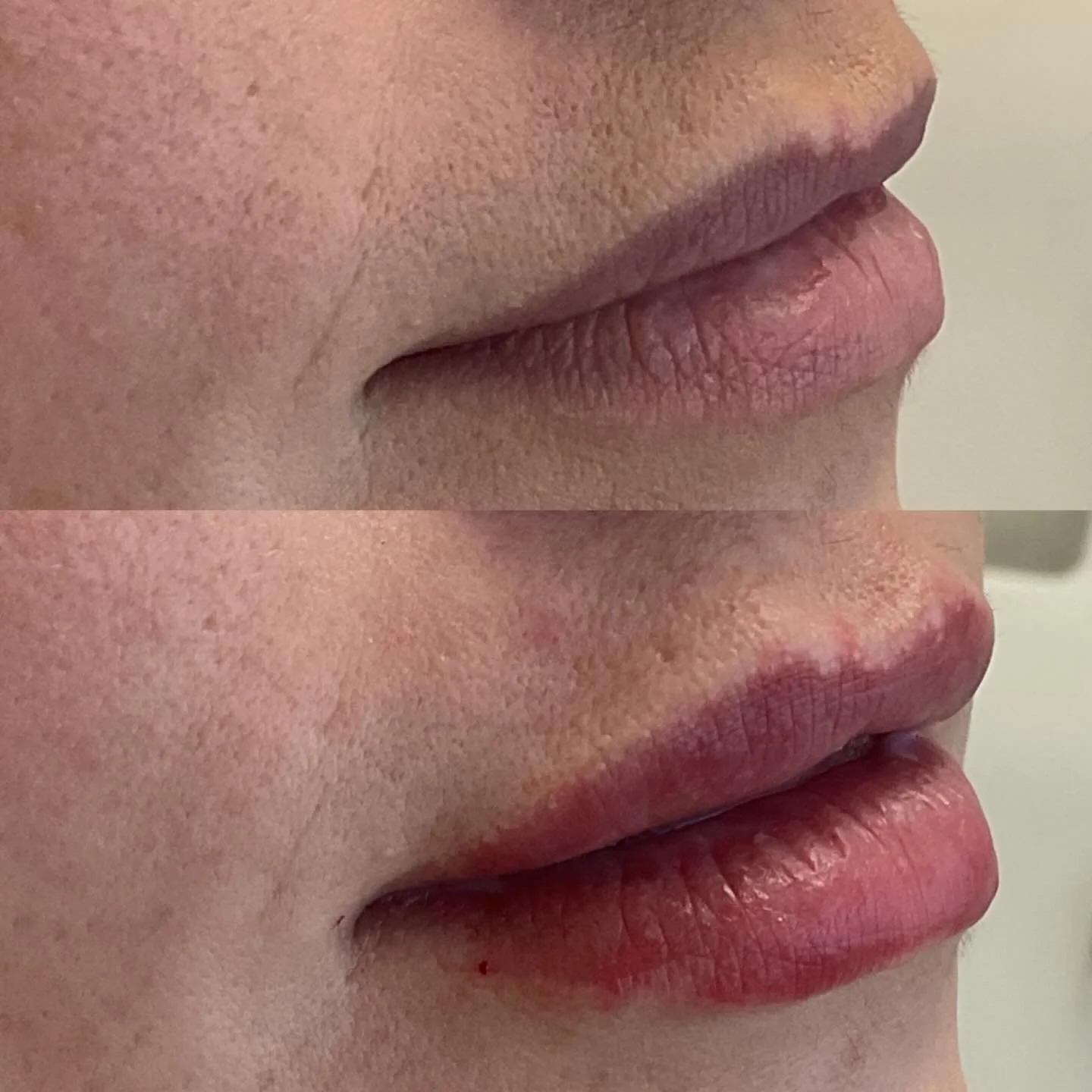 It doesn&rsquo;t have to be Valentine&rsquo;s Day to get pretty new lips! Lips by Amanda!👄 #newlips #naturallips #bestaestheticinjectors #juvedermultra #allergan