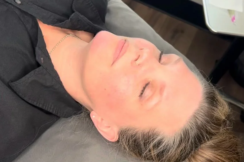 FACTORFIVE RDS PEEL before &amp; immediately after treatment 

The Renewal Dermal Solution Peel works as a chemical peel that helps to exfoliate the skin, removing dead cells and stimulating cell turnover. 

It&rsquo;s typically used to:

&bull;Impro