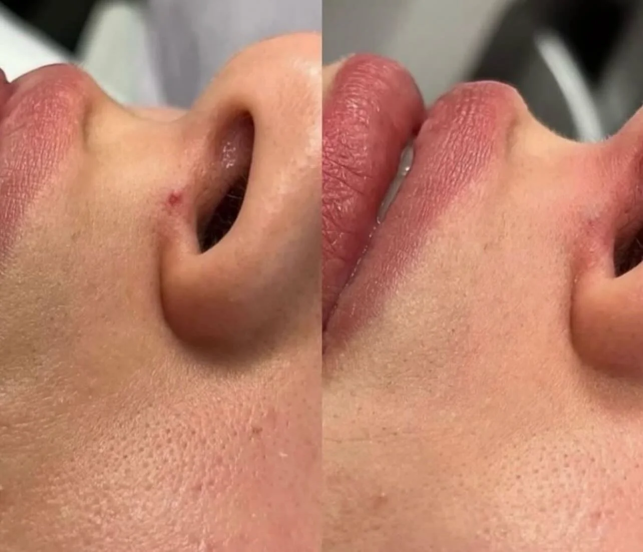 Cherry angioma removal 

🍒 Cherry angiomas are noncancerous red dots that form due to the clustering of blood vessels on the skin. 

🍒 They are a sign of aging, certain medical conditions, chemical exposure, climate factors and pregnancy.

🍒 Laser