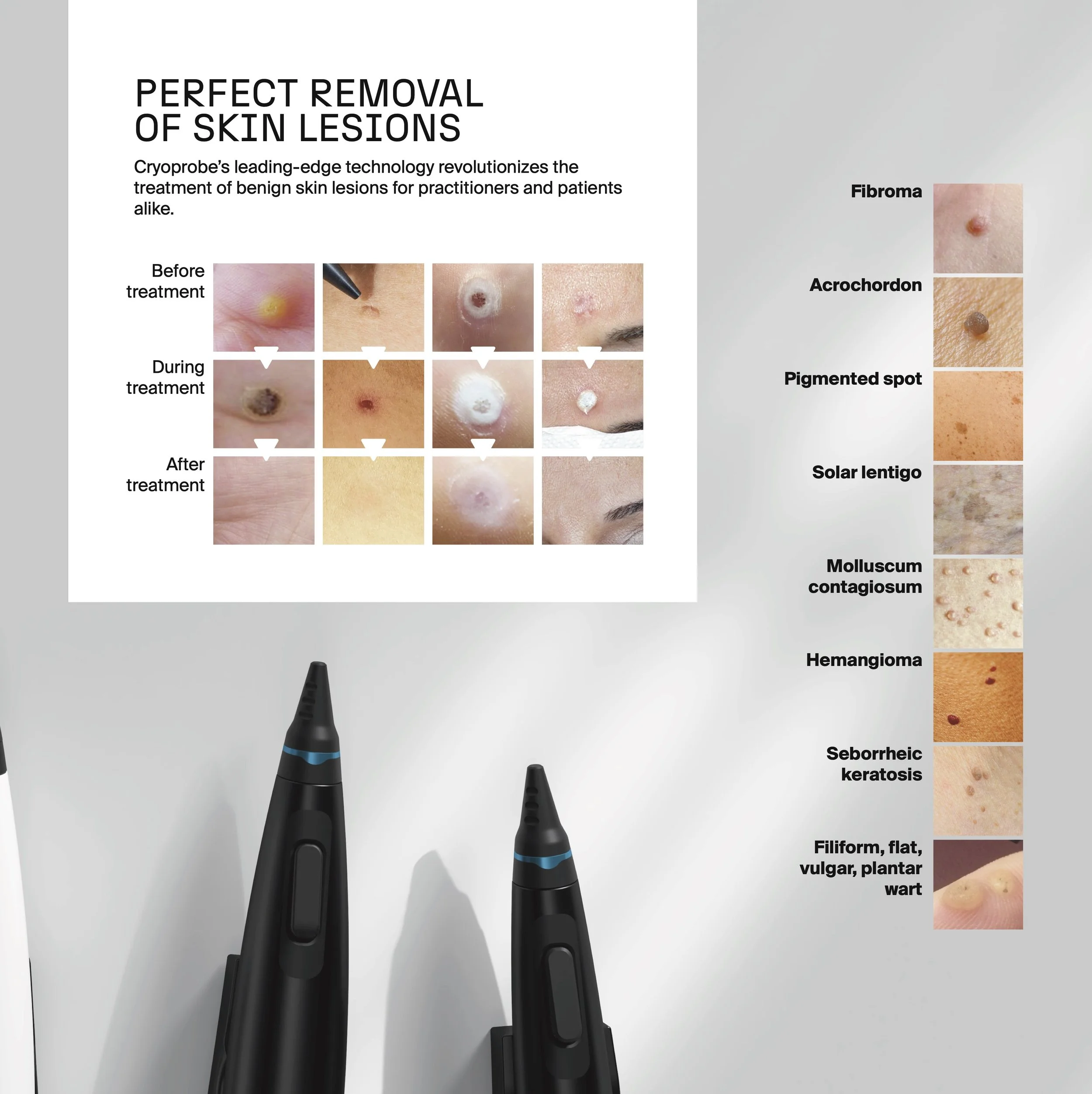 High-performance cryosurgery for easy, fast, and painless removal of skin lesions