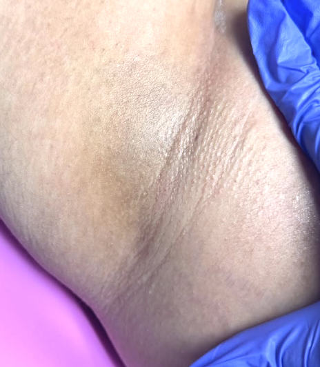Close-up of a person's skin with a blue glove touching it.