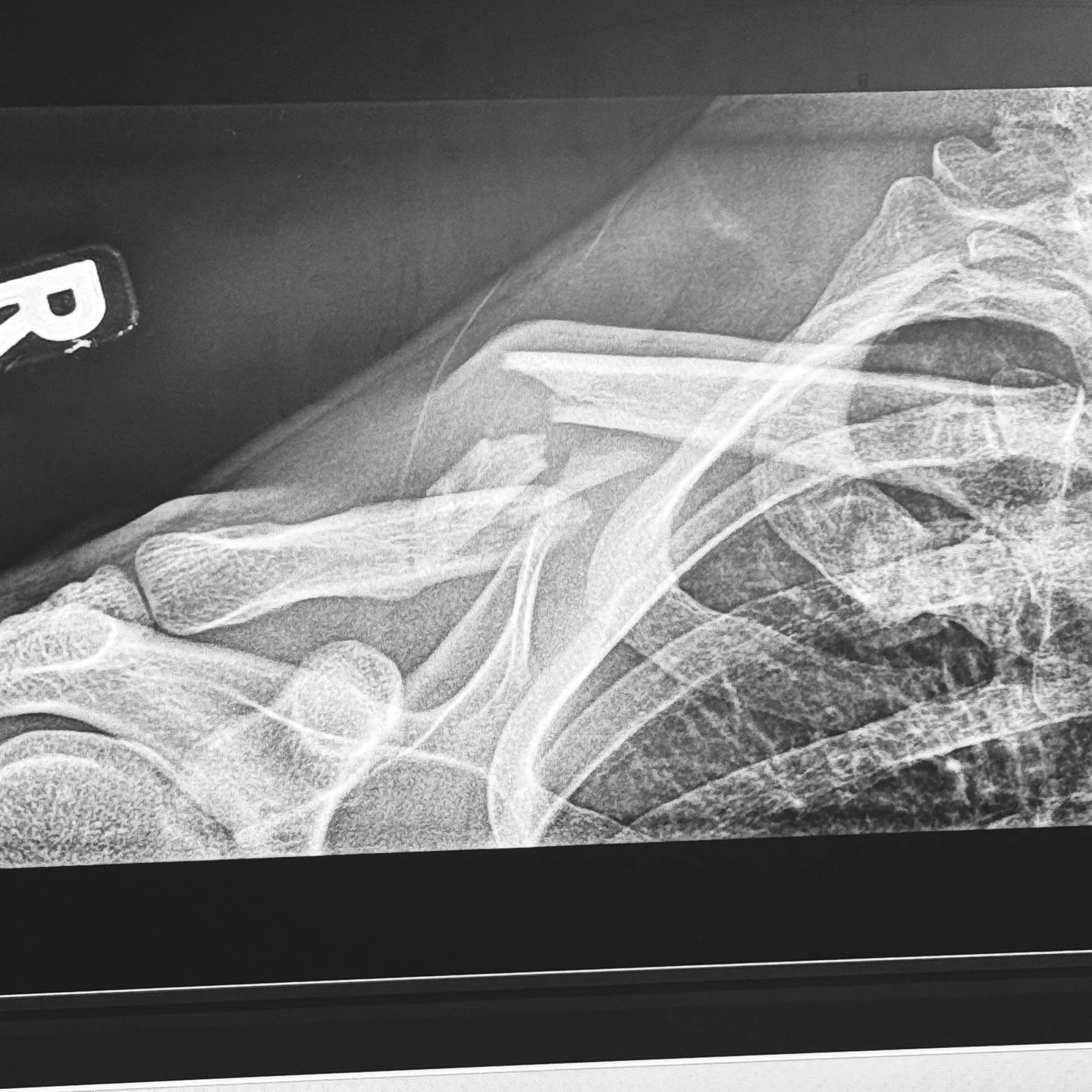 celebrated one week of oh oh ohio by shattering my collarbone playing hockey how&rsquo;d you guys celebrate? | for real tho thanks for the well wishes love you will be good in no time 🖤