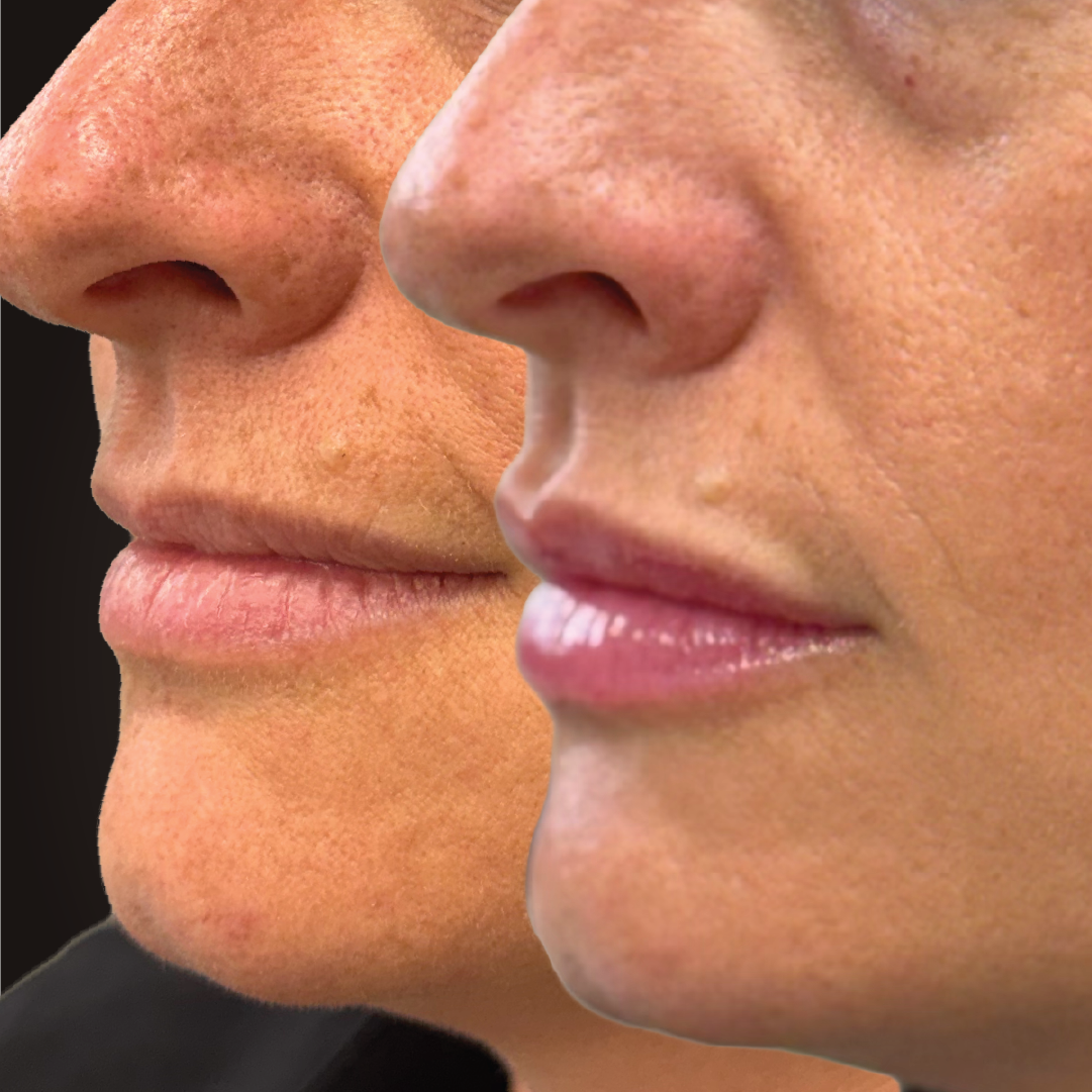 Lip Filler