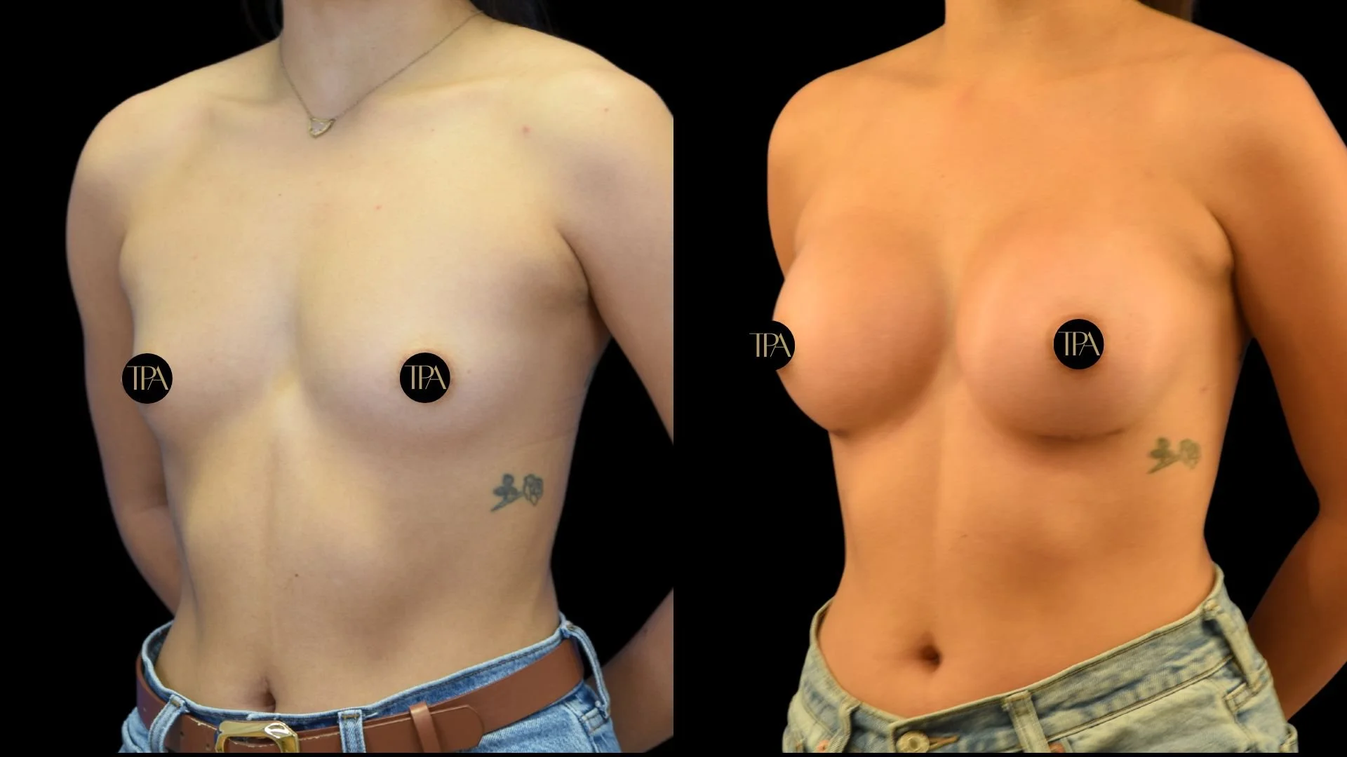 Comparison image of a woman's chest before and after cosmetic breast augmentation surgery, with the left side showing smaller breasts and the right side showing larger, fuller breasts.