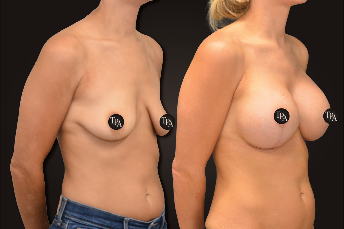 Breast Augmentation