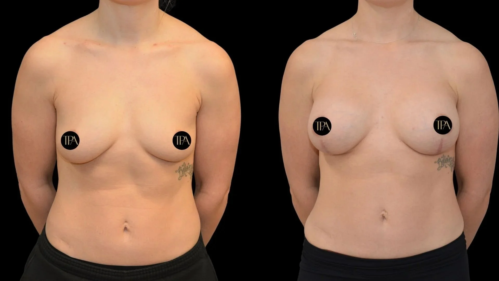 Before and after images of a woman's bare chest, showing a cosmetic surgery transformation with changes in breast size and shape.