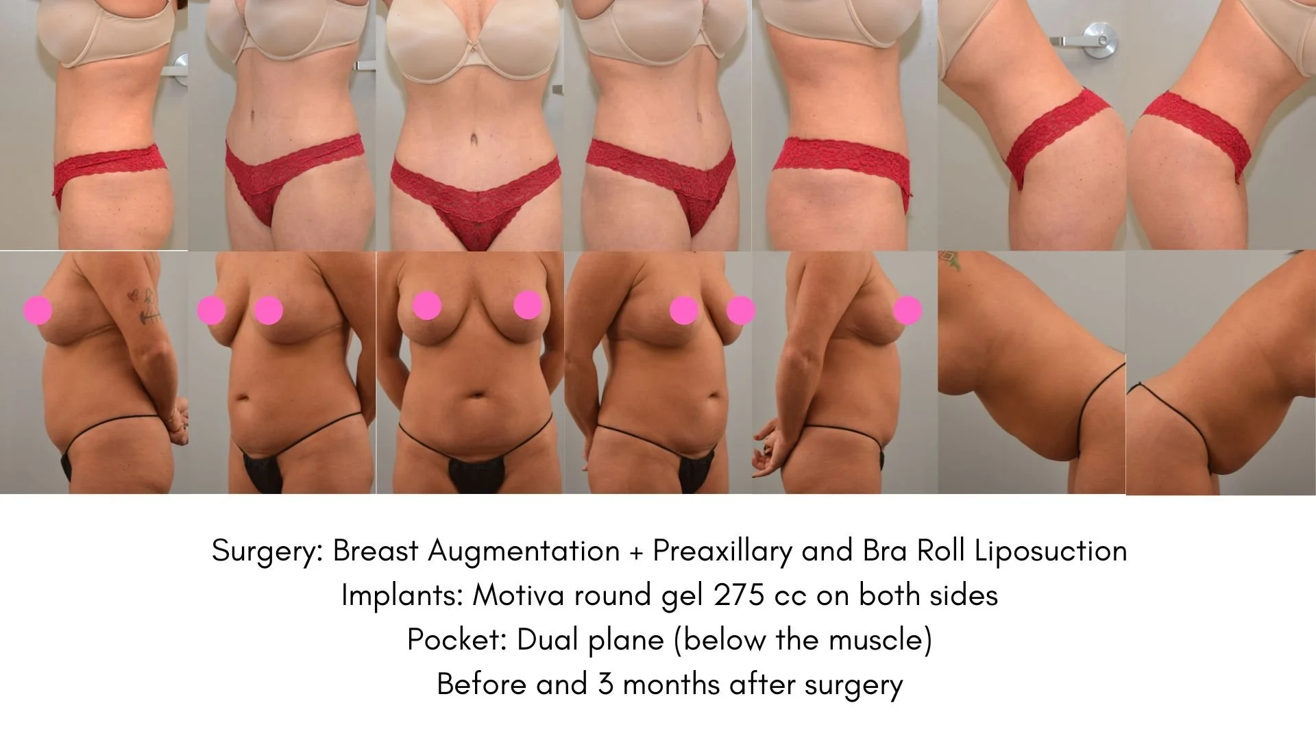 Series of before and after photos of a woman’s upper and lower body from side, front, and back views, showing results after breast augmentation, preaxillary and bra roll liposuction, with implants of Motiva round gel 275 cc, and dual plane pocket, ta