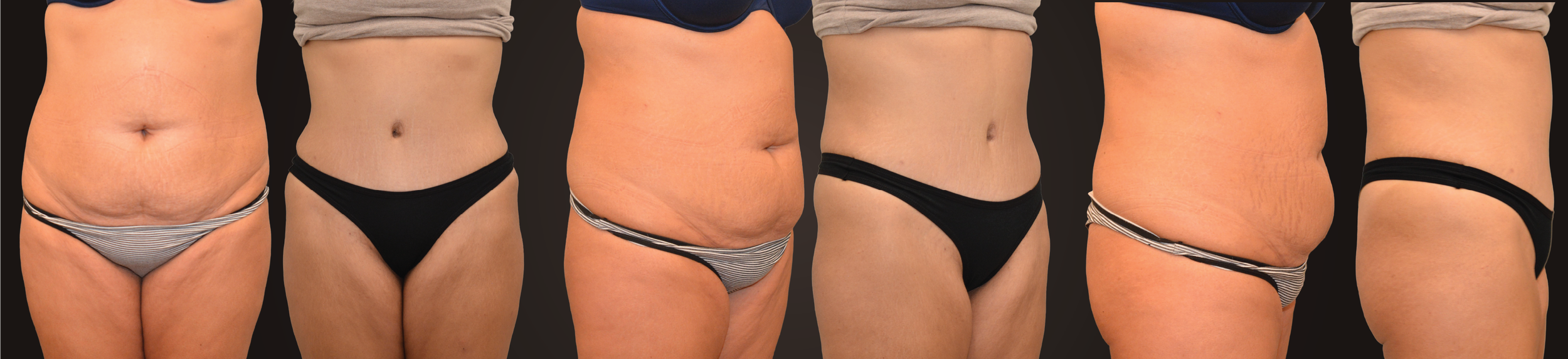 Full Abdominoplasty with flank liposuction