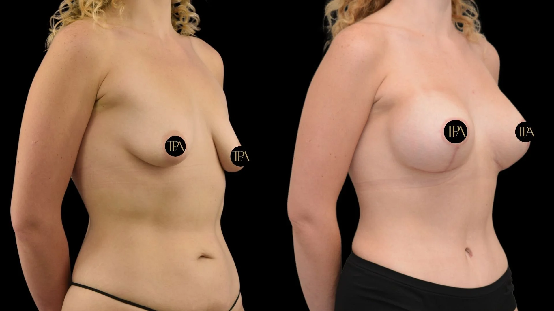 Side-by-side images of a woman before and after breast enhancement surgery, showing her upper body from the shoulders to the waist, with black circles covering her nipples that have the label "TPA".