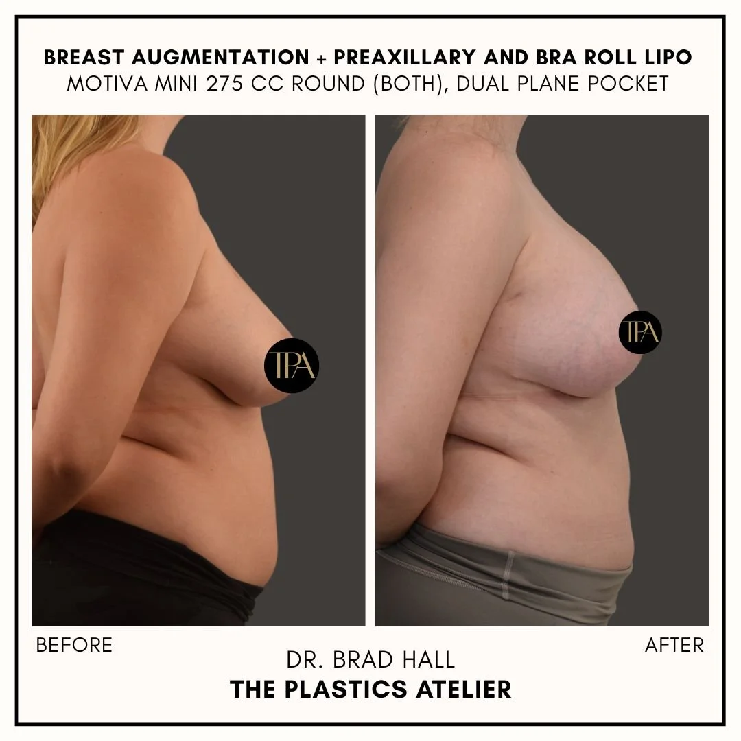 Side-by-side comparison of a woman's breast before and after augmentation with text indicating breast augmentation and breast implant details. The left image shows the breast before surgery, and the right image shows the breast after surgery. The ima