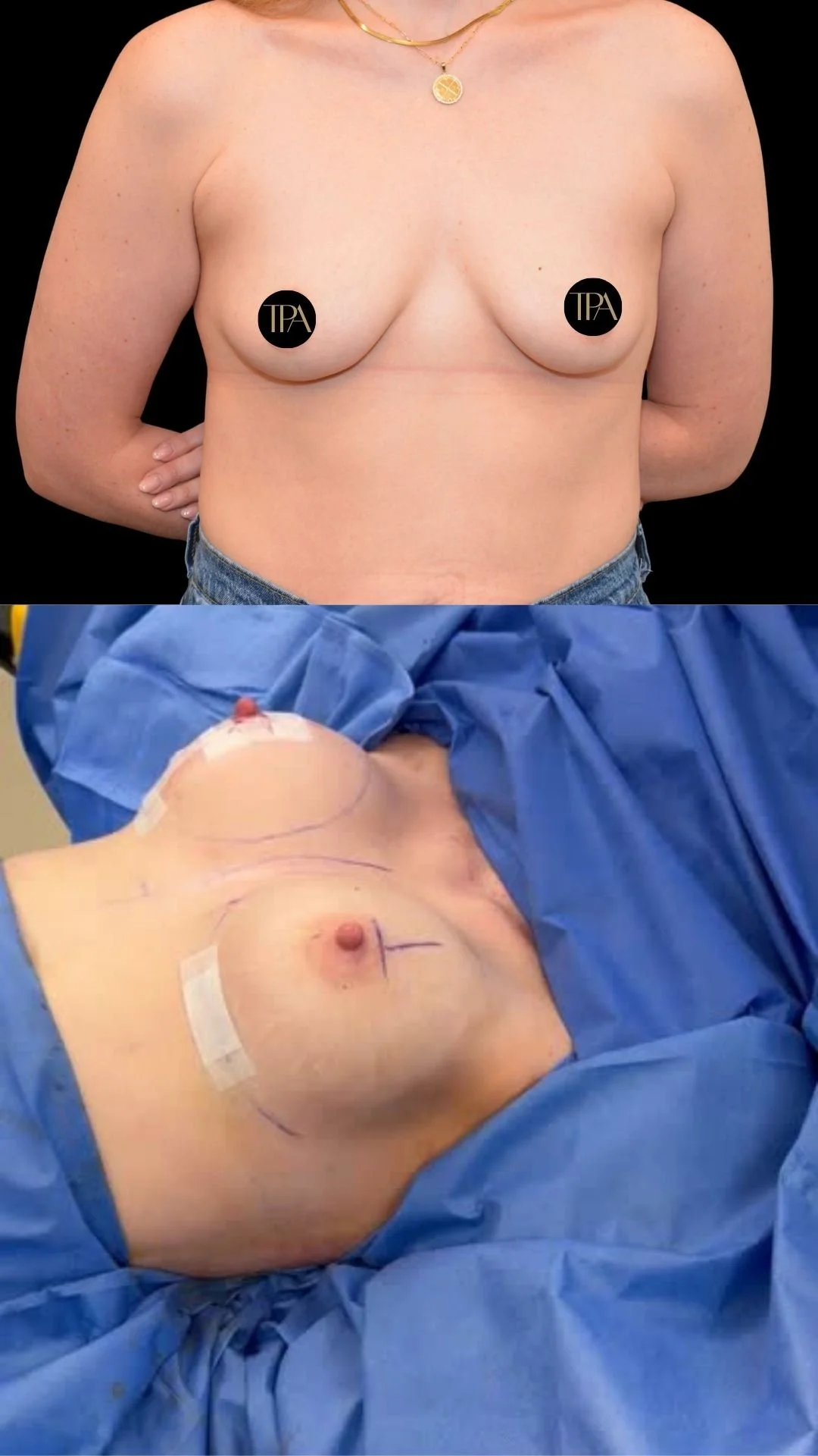 Top image shows a woman's bare chest before breast surgery, with black stickers covering nipples that have 'TFA' printed on them. The woman is wearing a gold necklace and denim jeans, with her arms behind her back. The bottom image shows her chest du