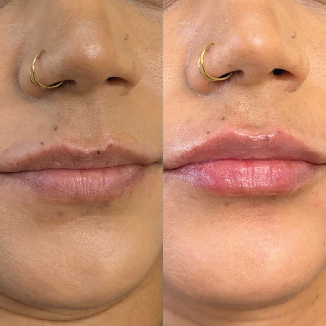 Lip Filler