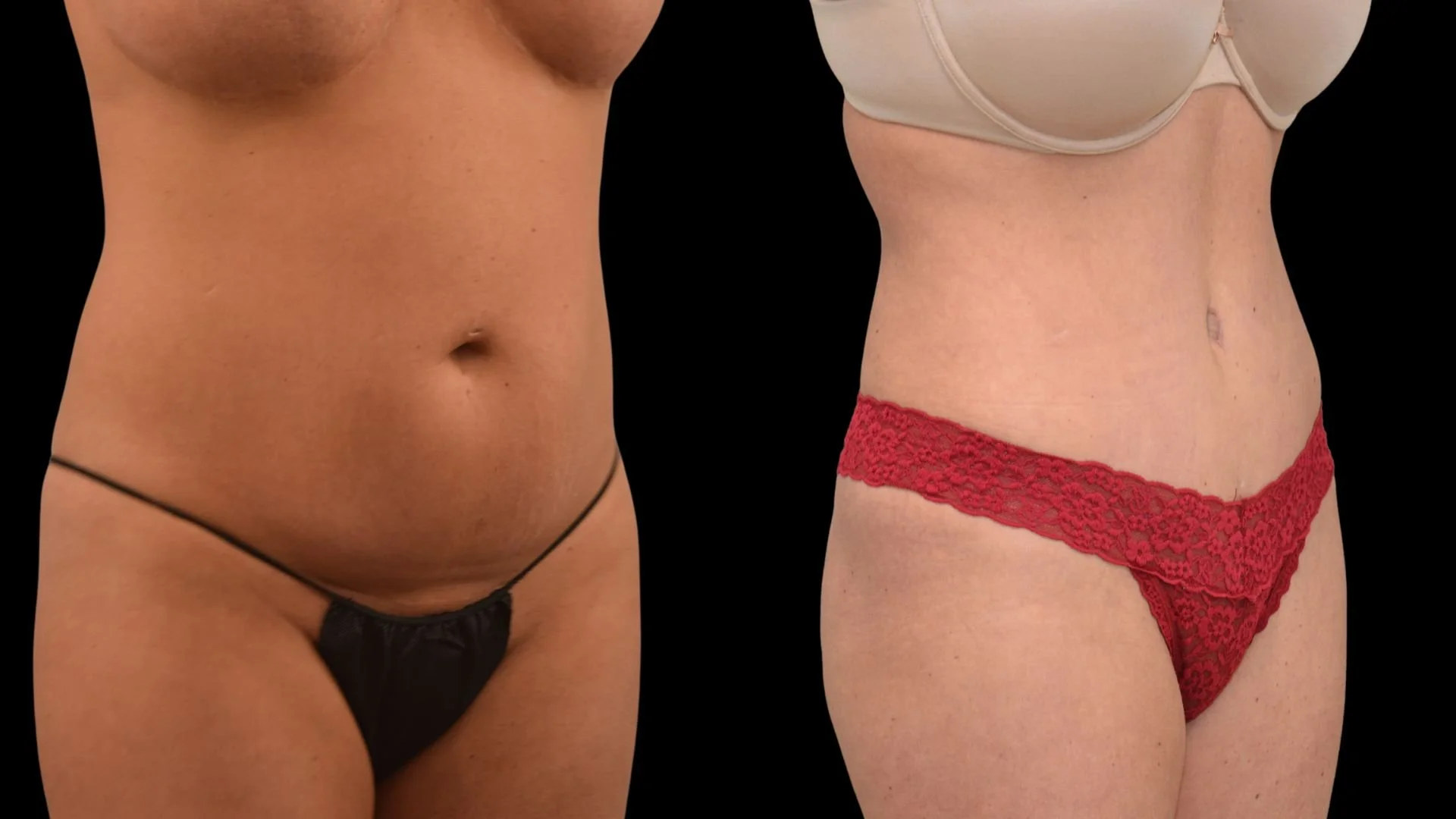 Comparison of a woman's abdomen before and after a cosmetic procedure, showing reduced abdominal fat and improved skin tightness.