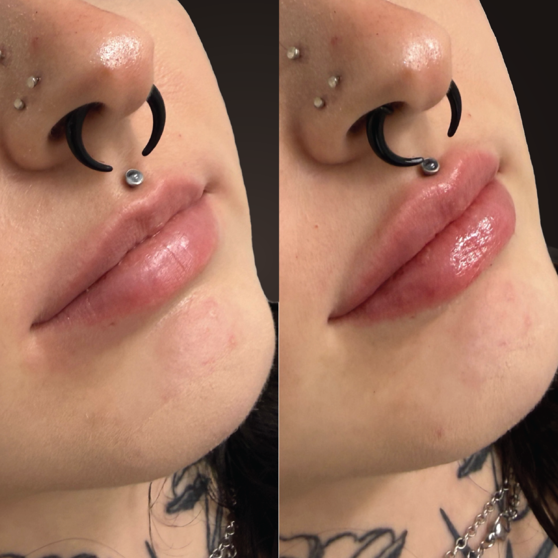Lip filler