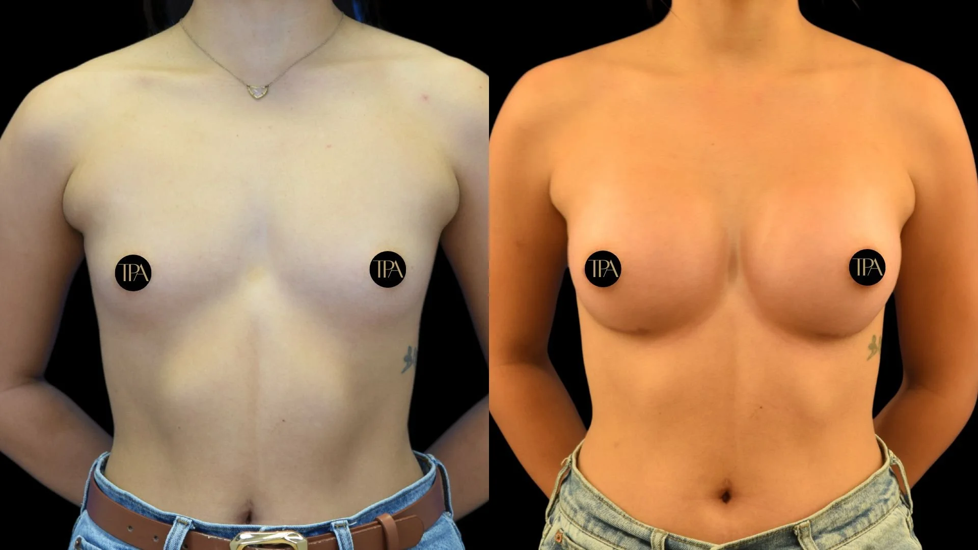 Side-by-side comparison of a woman's bare chest before and after breast enhancement surgery, with black circles covering nipples labeled 'TPA'.