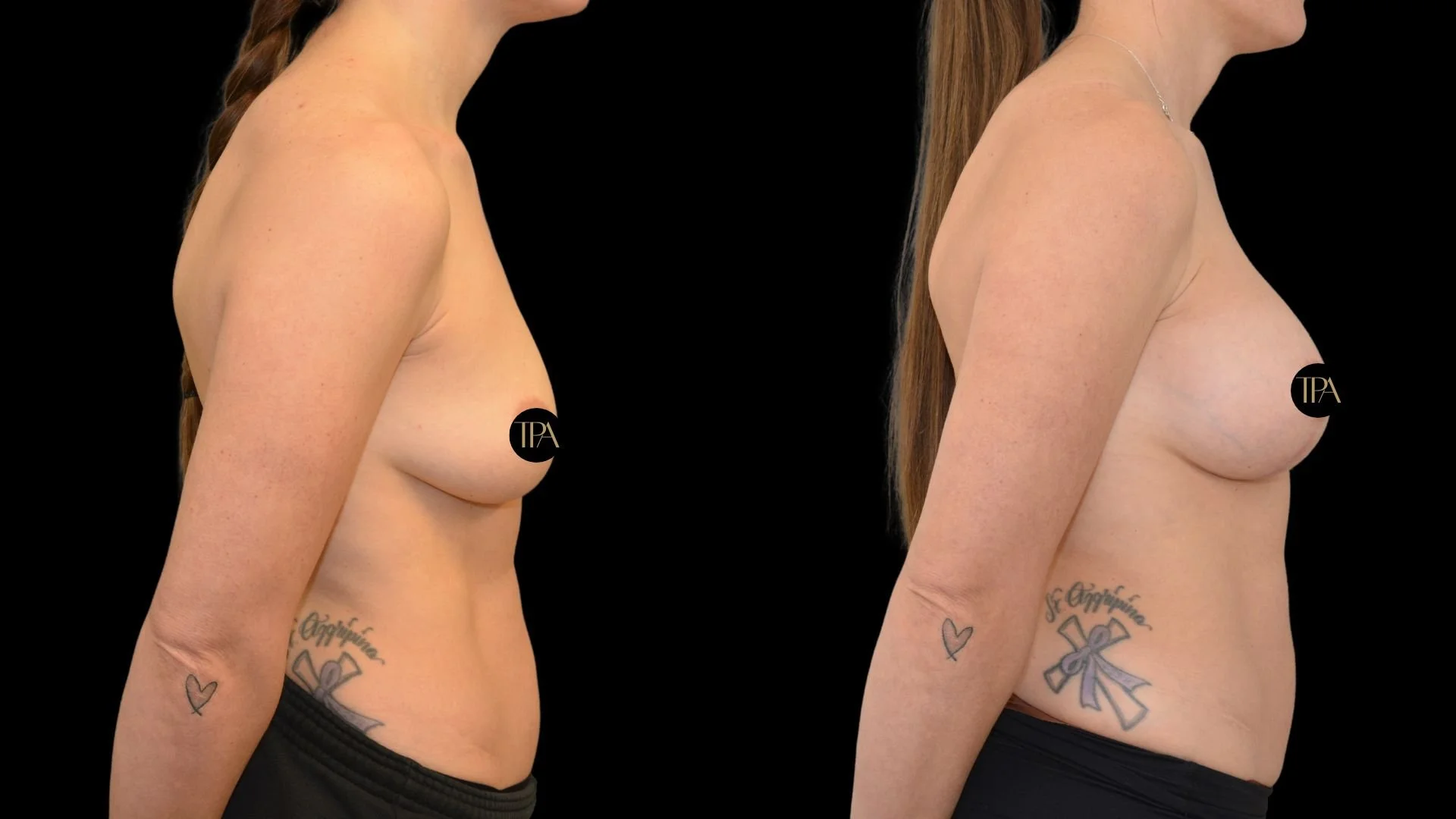 Before and after side views of a woman's upper body showing breast enhancement results with tattoos on her left side.