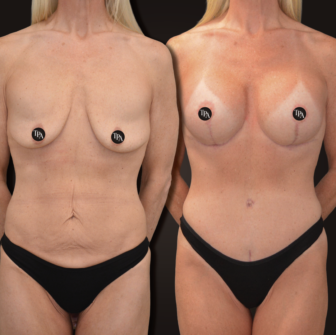 Breast lift and Augmentation with mesh
425 cc • round/demi profile • dual plane