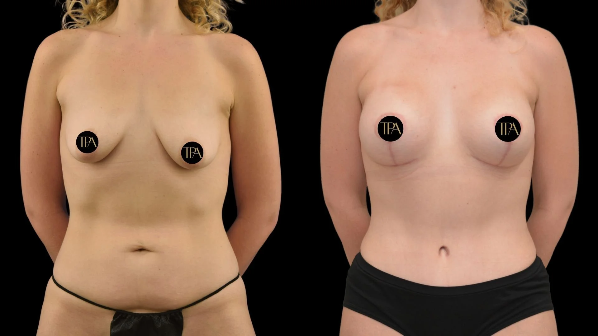 Side-by-side comparison of a woman's chest before and after cosmetic breast surgery, with black censoring circles covering her nipples and a black background.
