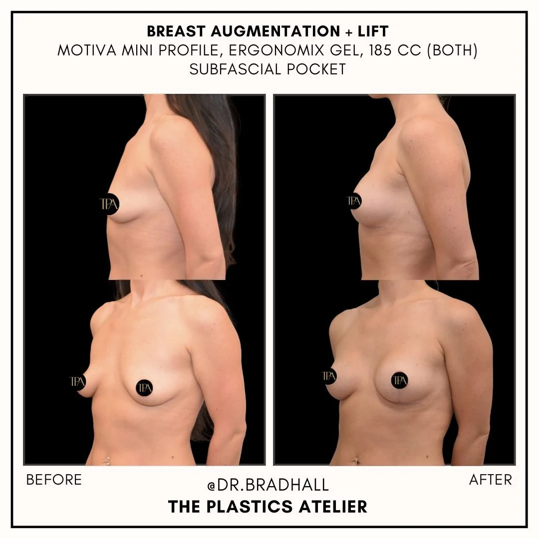 Before and after photos showing breast augmentation and lift results of a woman with side and front views, indicating a cosmetic surgical procedure.