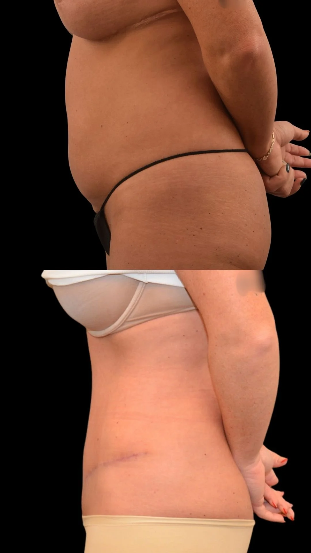 Close-up side views of a woman's torso and pelvis, wearing minimal clothing, with a black background.