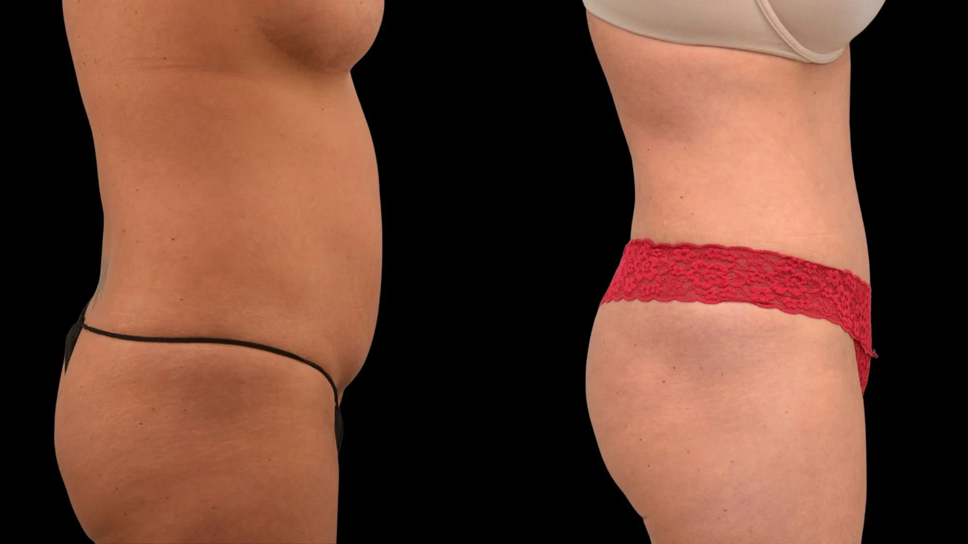 Side-by-side comparison of a woman's torso and hips before and after body transformation, with the left side showing a less toned abdomen and the right side showing a more toned abdomen with red lace underwear.
