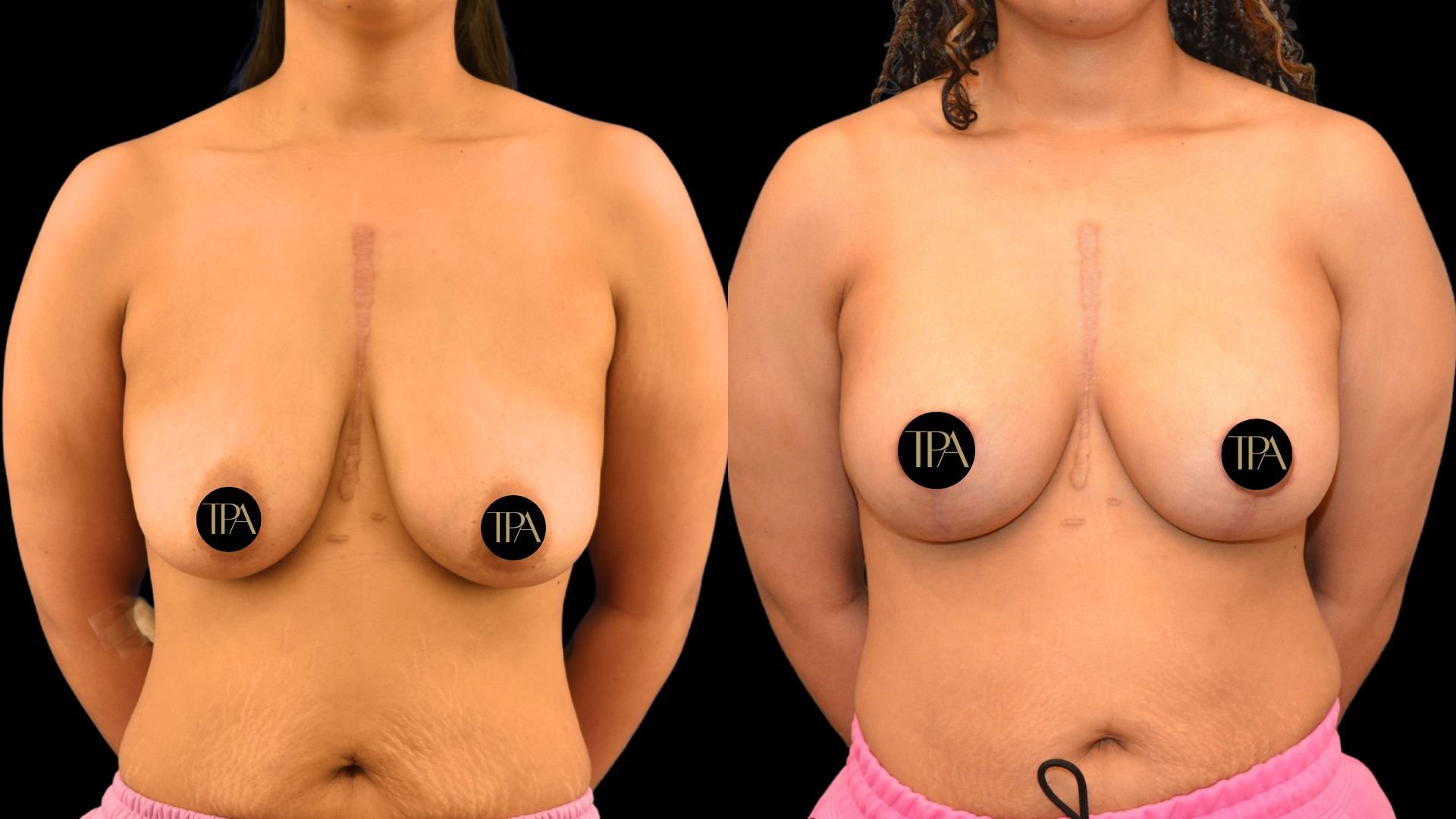 Side-by-side comparison of two women with exposed breasts, with black circles covering nipples containing the text "TPA". Both women have visible stretch marks and are wearing pink shorts, with a black background.