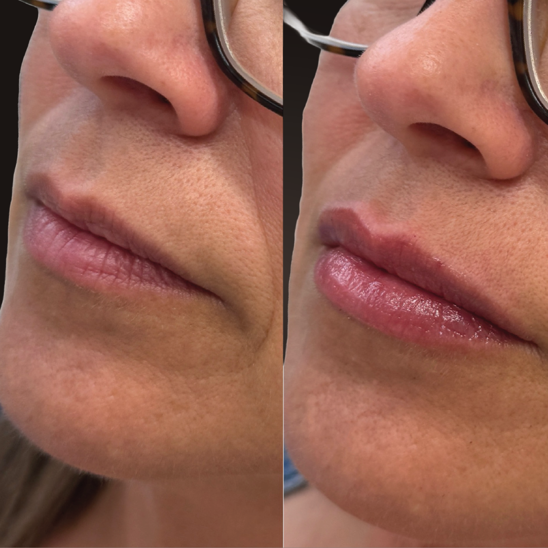 Lip Filler