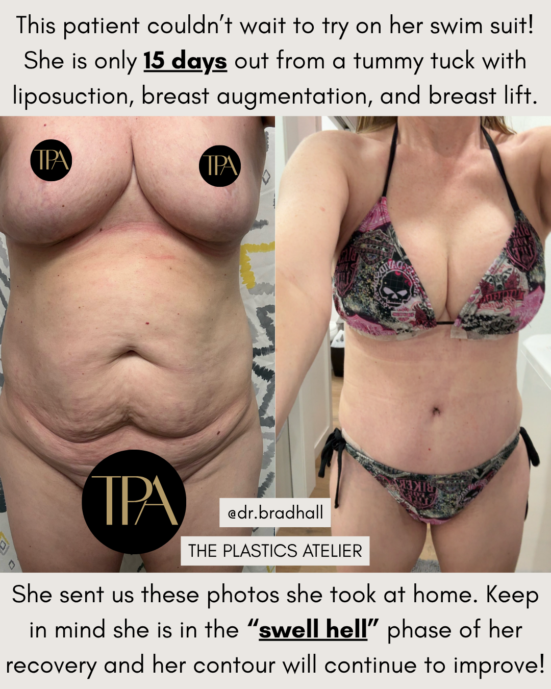 Before and after photos of a woman showing her abdominal area and breasts, highlighting a tummy tuck, liposuction, breast augmentation, and breast lift, taken 15 days apart during recovery.