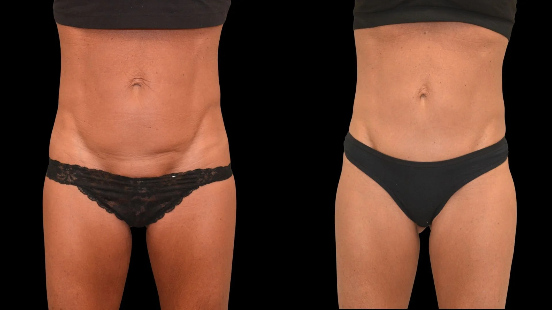Comparison of woman's abdomen before and after body contouring treatment, showing reduced fat and improved skin tightness.