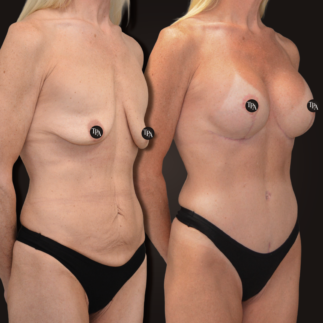 Breast lift and Augmentation with mesh
425 cc • round/demi profile • dual plane