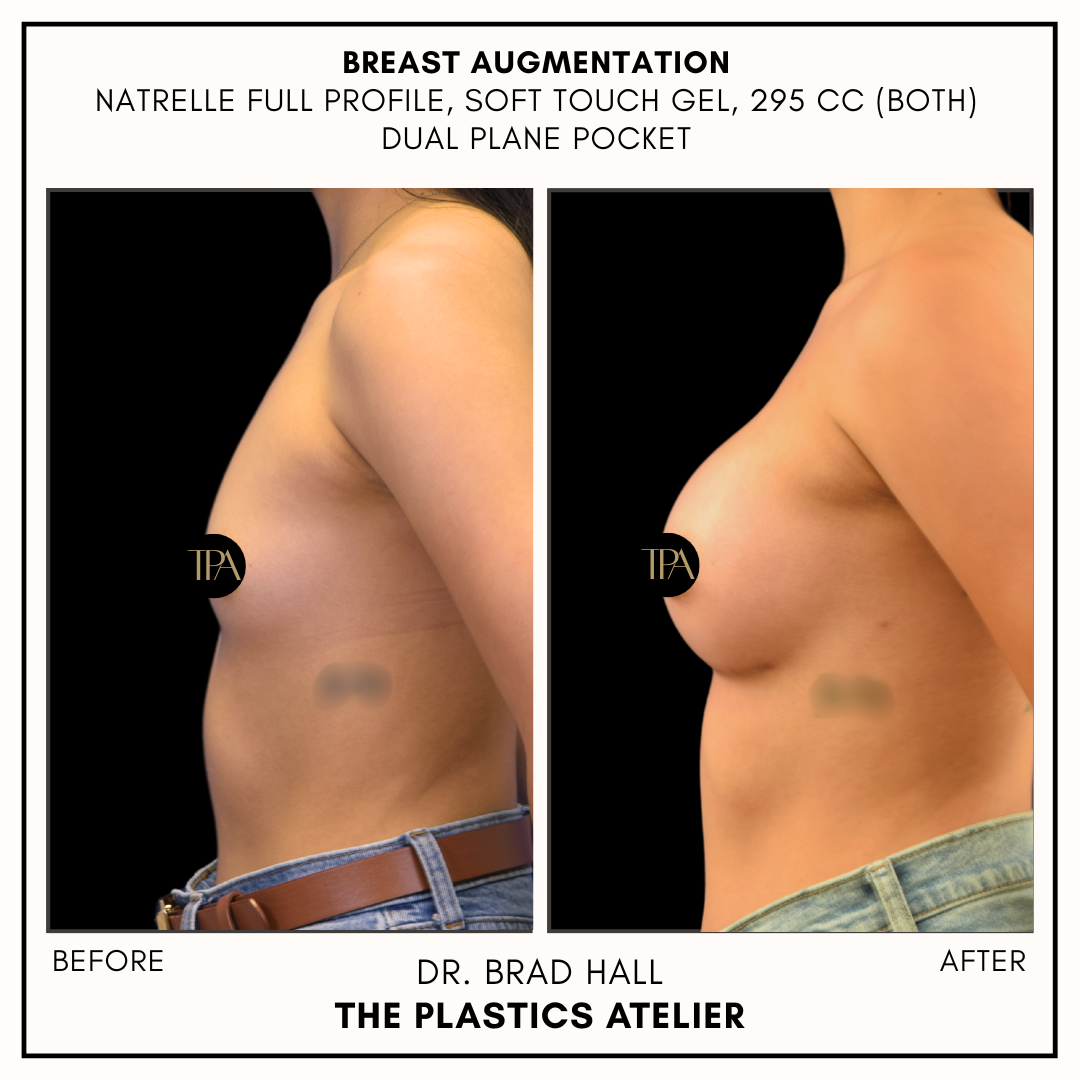 Comparison of a woman's side profile before and after breast augmentation surgery showing increased breast size and enhanced shape.