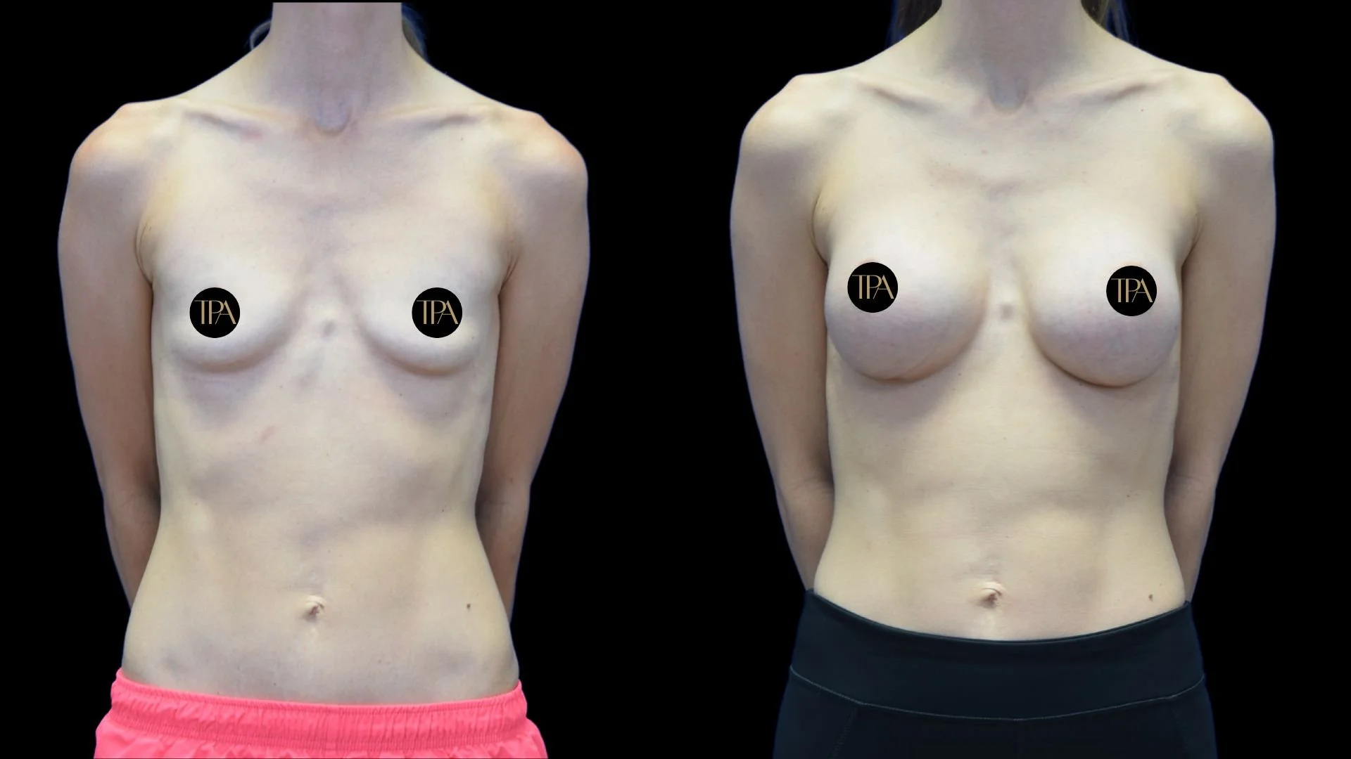 Comparison of before and after breast augmentation on mannequin torso, with black background, showing changes in breast size and shape.