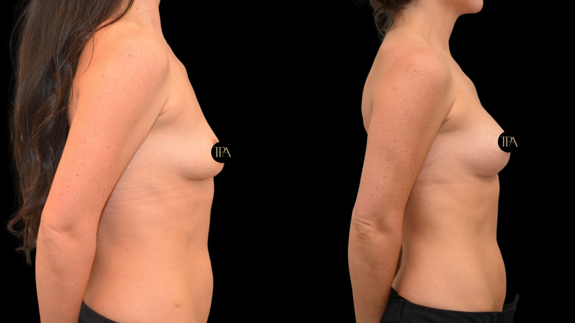 Side-by-side comparison of a woman's torso before and after breast augmentation surgery.