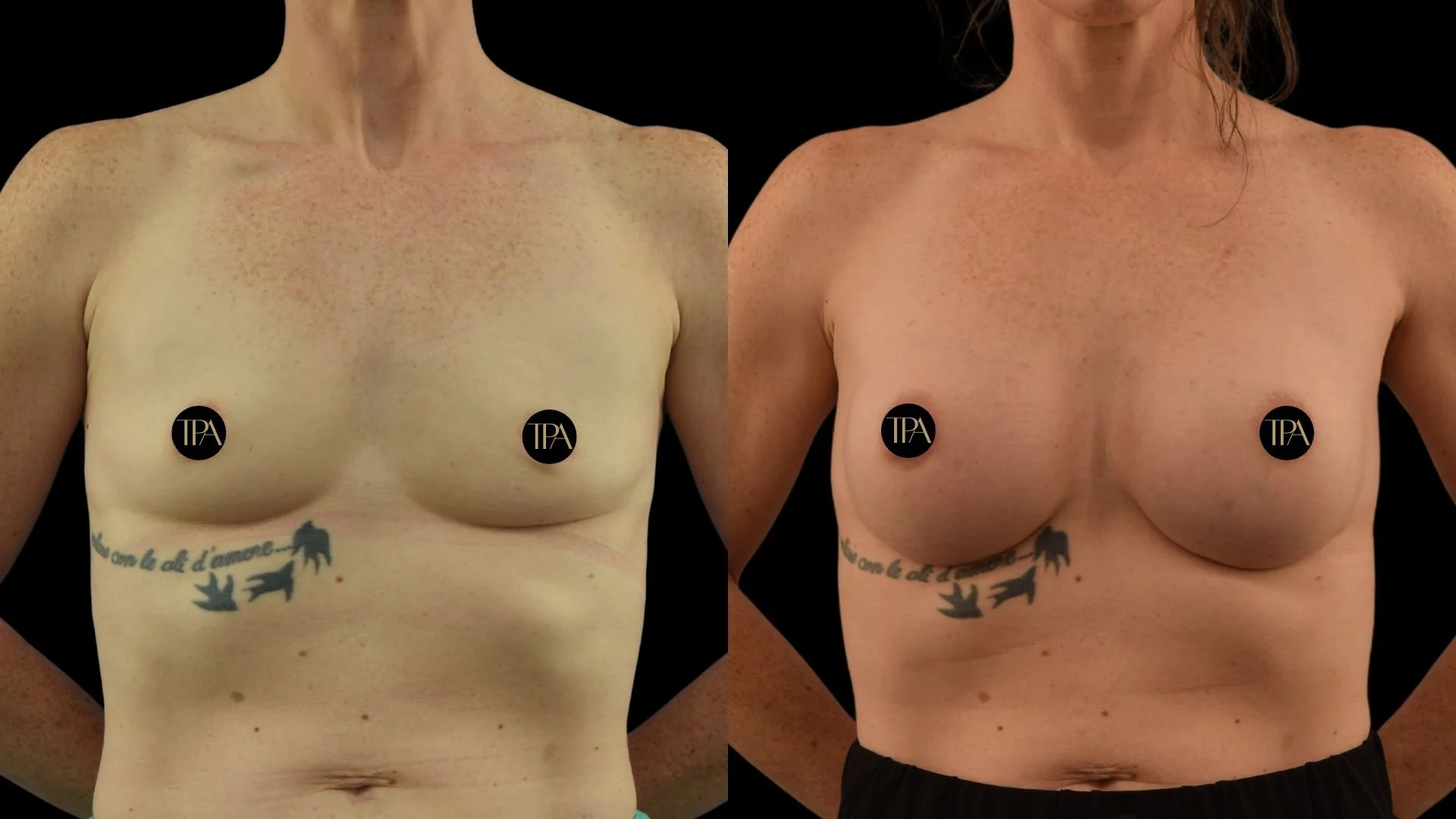 Comparison of a woman's bare chest before and after breast augmentation, with tattoos below. Clothes are removed from the chest area, against a black background.