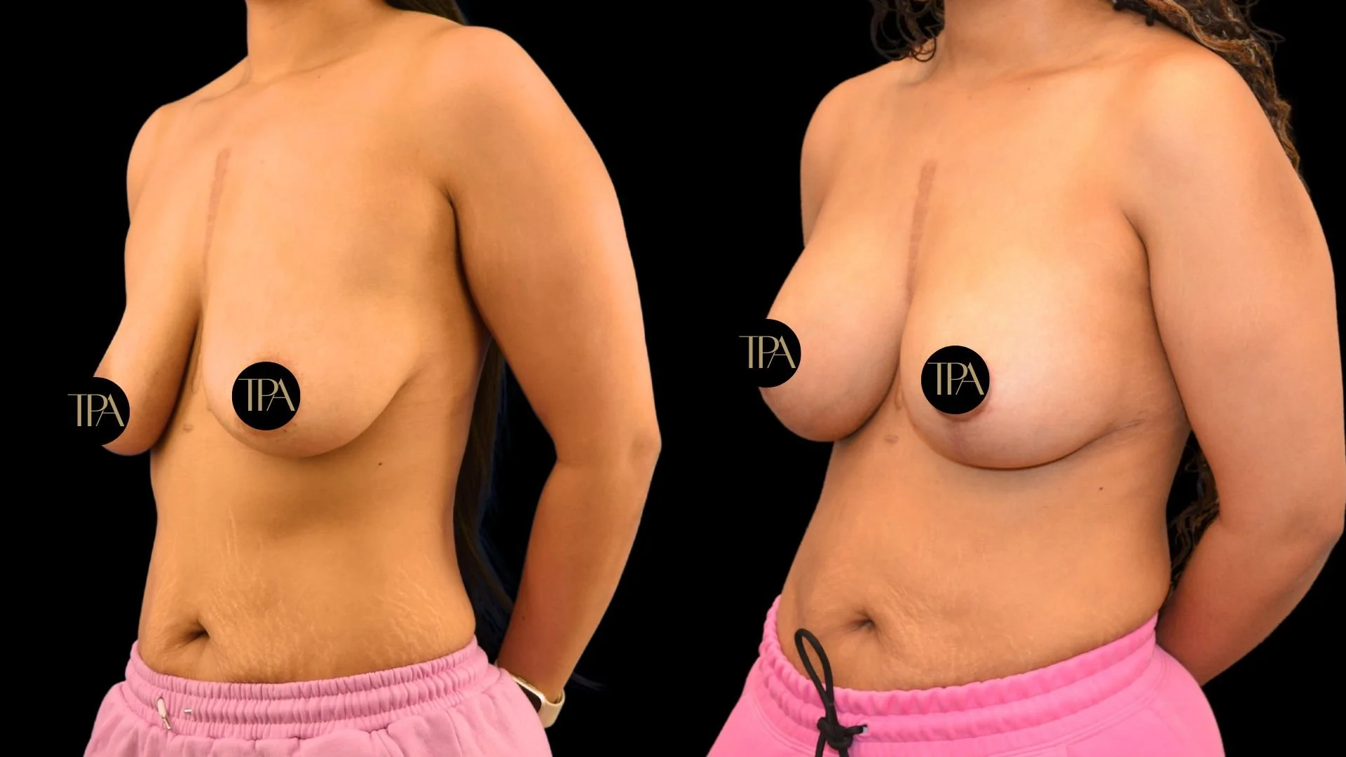 Comparison of two topless women in pink shorts, showing their torsos and breasts against a black background.