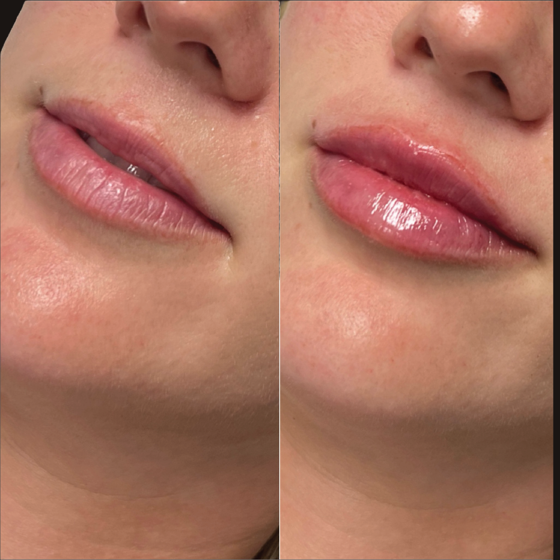 Lip Filler