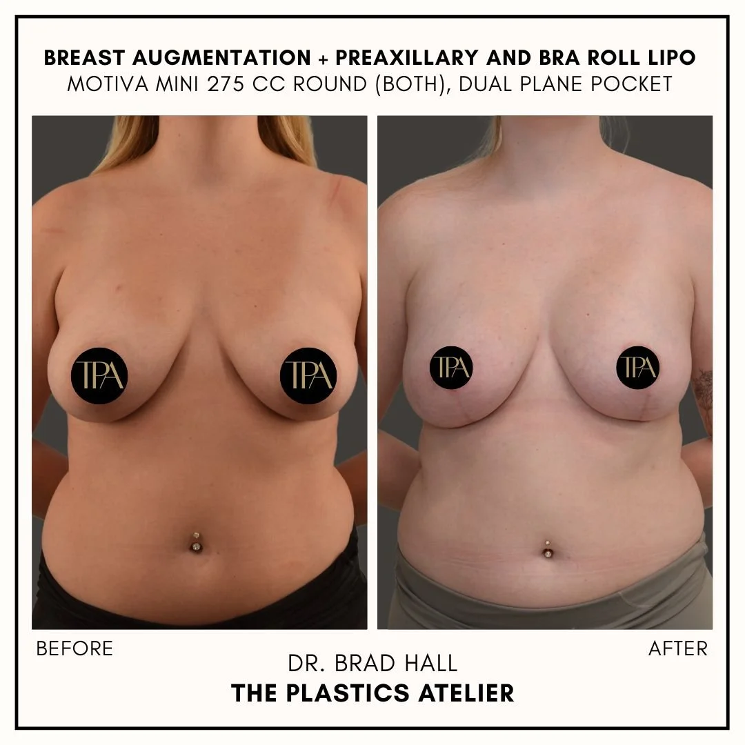 Side-by-side comparison of a woman before and after breast augmentation surgery, showing a noticeable increase in breast size and shape, with the 'before' image on the left and the 'after' image on the right. The image includes text indicating the pr