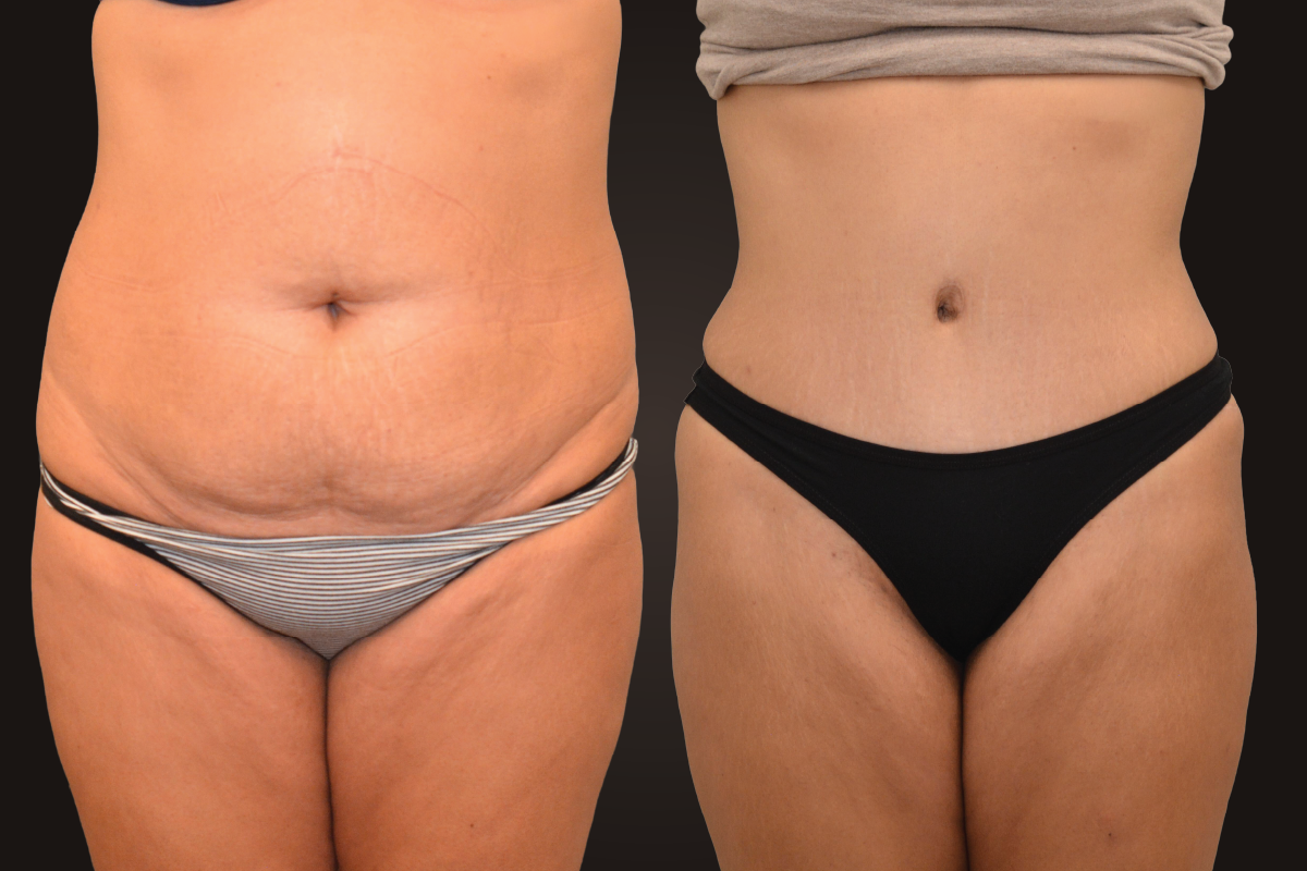 Abdominoplasty