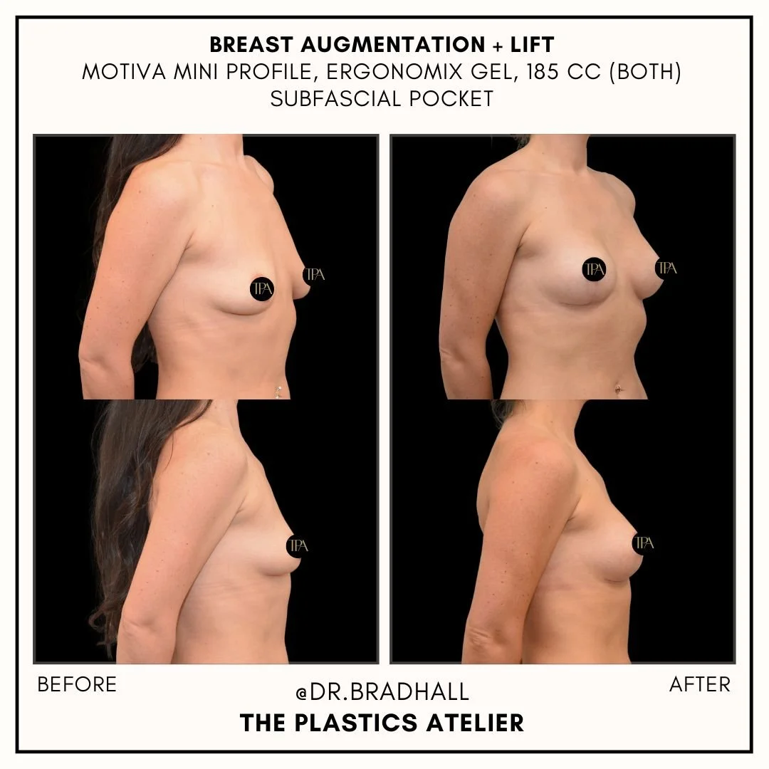 Side-by-side comparison of a woman's upper body before and after breast augmentation and lift surgery. The left side shows the 'before' images with smaller breasts, and the right side shows the 'after' images with larger, lifted breasts. The images a