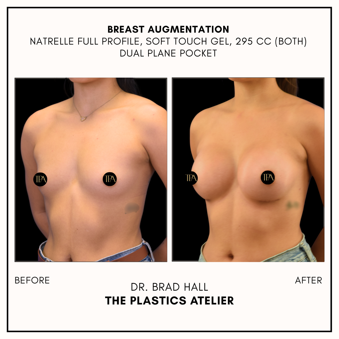 Side-by-side comparison of woman's chest before and after breast augmentation surgery, showing increased breast size and shape, with text indicating the procedure with Natrelle Full Profile, soft touch gel, 295 cc, dual plane pocket, performed by Dr.