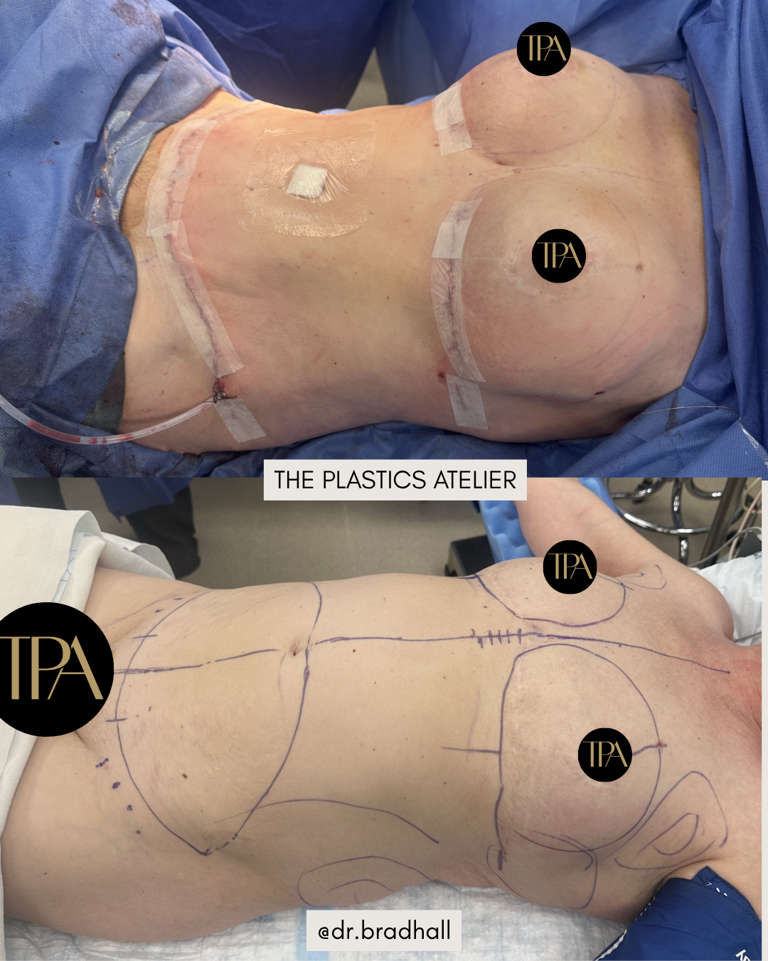 Before and after images of a breast augmentation or reconstructive surgery showing marking and incision sites on a woman’s chest, with the text "The Plastics Atelier" and the Instagram handle "@dr.bradhall."