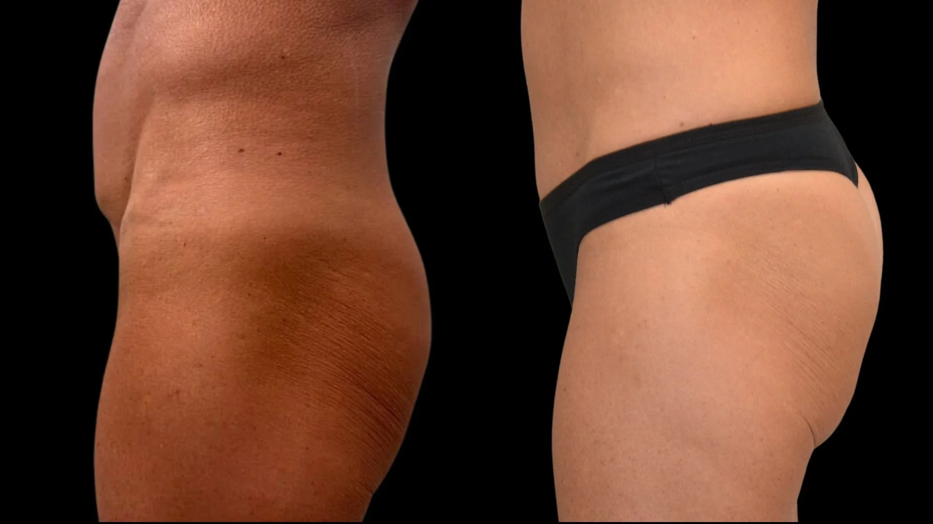 Close-up of two women's hips; one in black underwear, showing skin tightening before and after treatment or exercise.