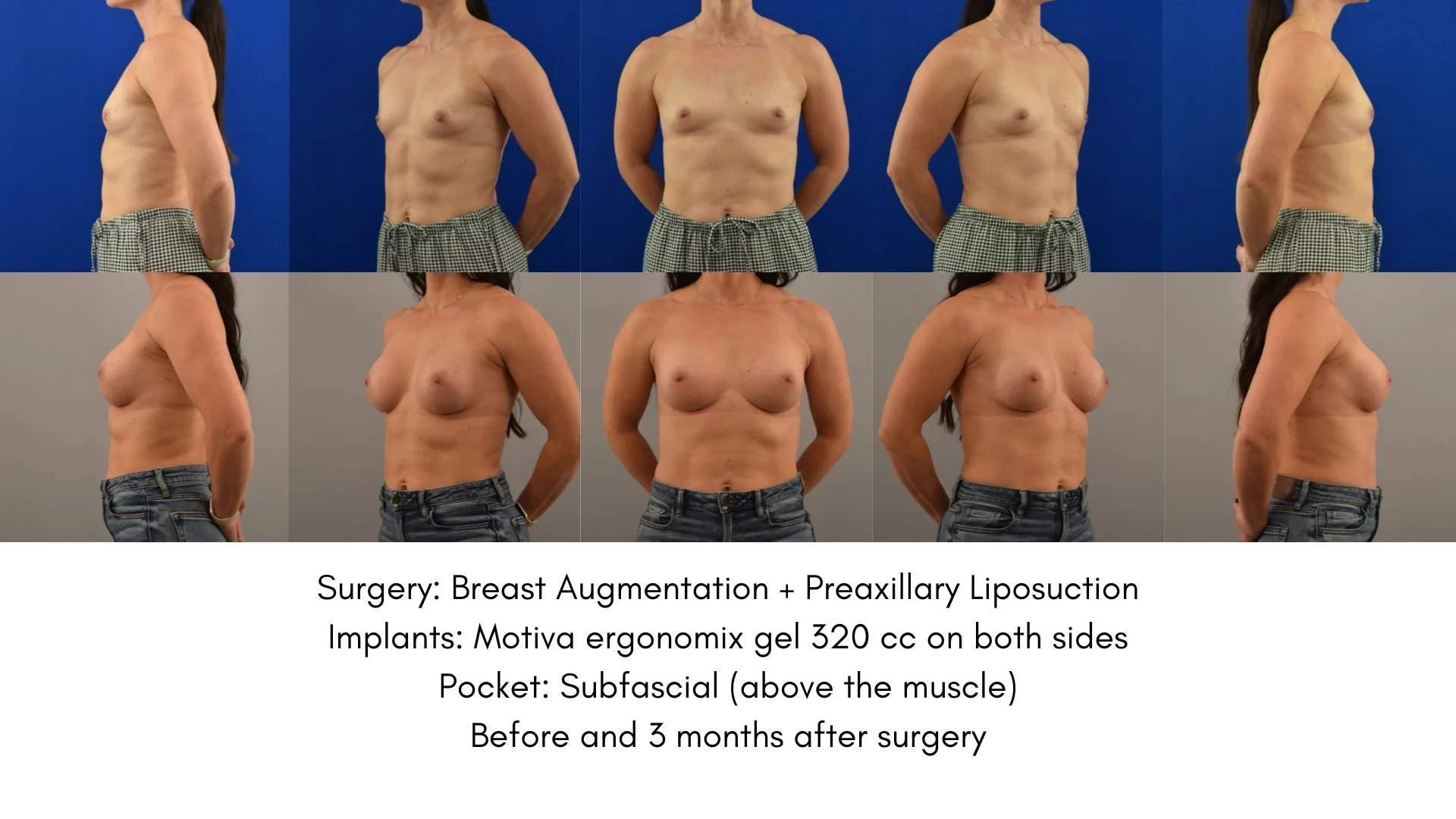 Series of before-and-after photos showing a woman’s torso after breast augmentation and liposuction. The top row shows the woman with smaller breasts and a thinner waist, while the bottom row shows her with larger breasts and a fuller waist. The imag