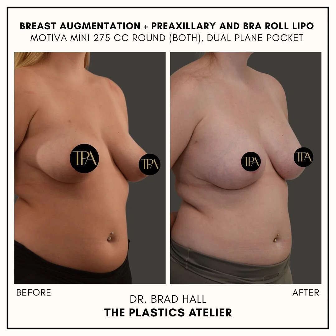 Side-by-side before and after photos of a woman showcasing breast augmentation results, with the 'before' on the left and 'after' on the right. The images are part of a promotional graphic for Dr. Brad Hall at The Plastics Atelier, highlighting the p