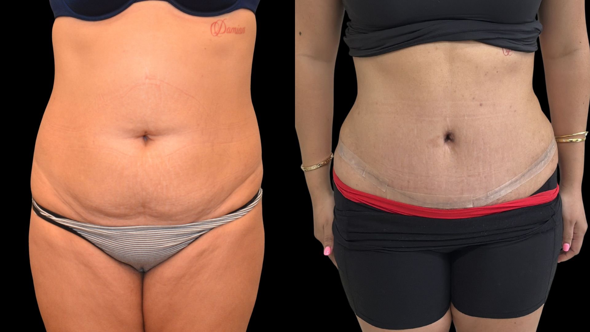 Comparison of a woman's abdominal area before and after a cosmetic procedure, showing a reduction in belly size and improved skin tone.