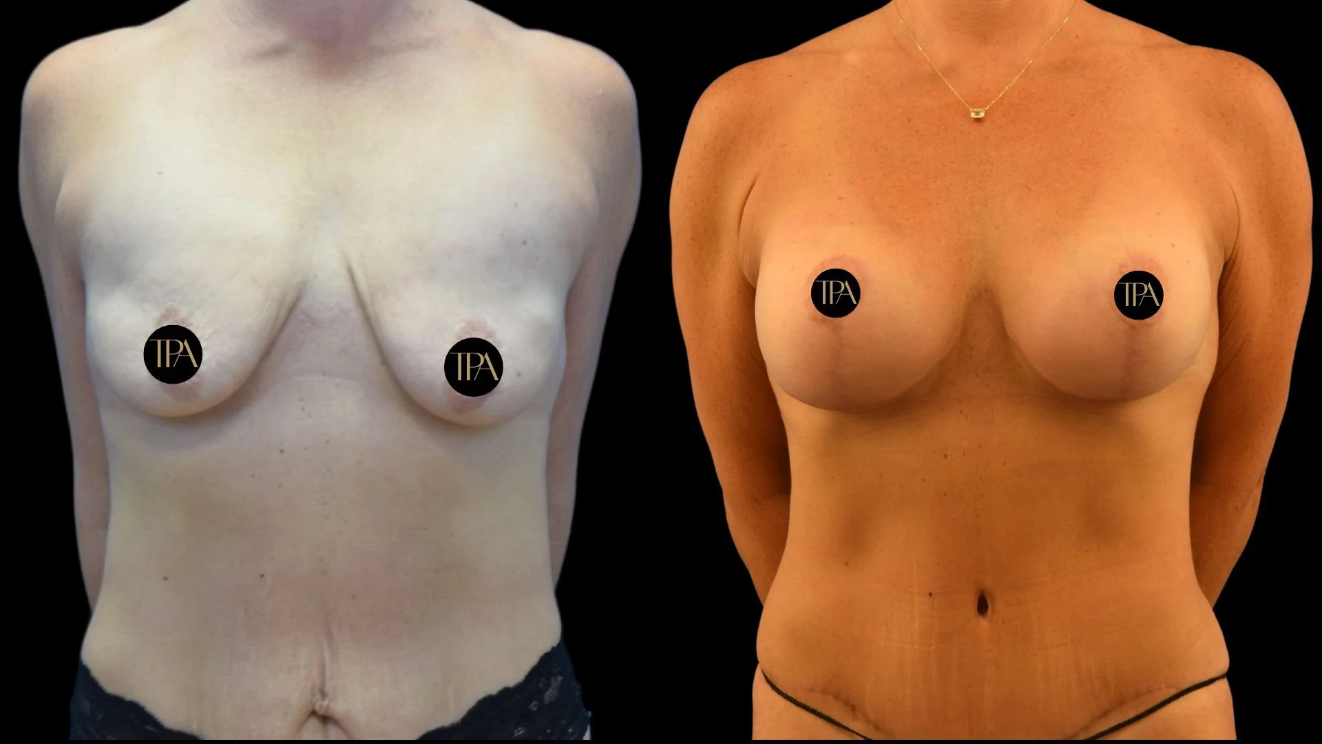Comparison of a female's bare chest before and after breast augmentation surgery, with black censor circles covering nipples.