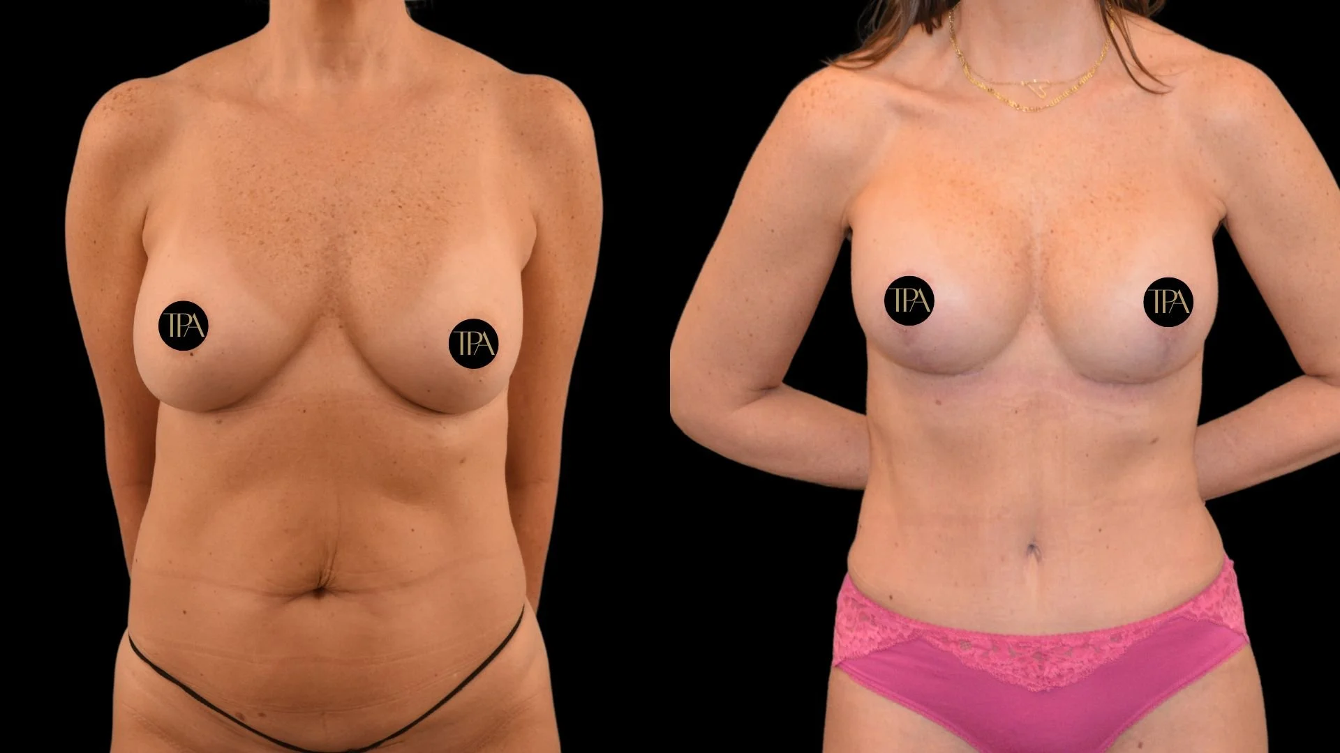 Comparison of a woman's chest before and after breast augmentation surgery, showing changes in size and shape.