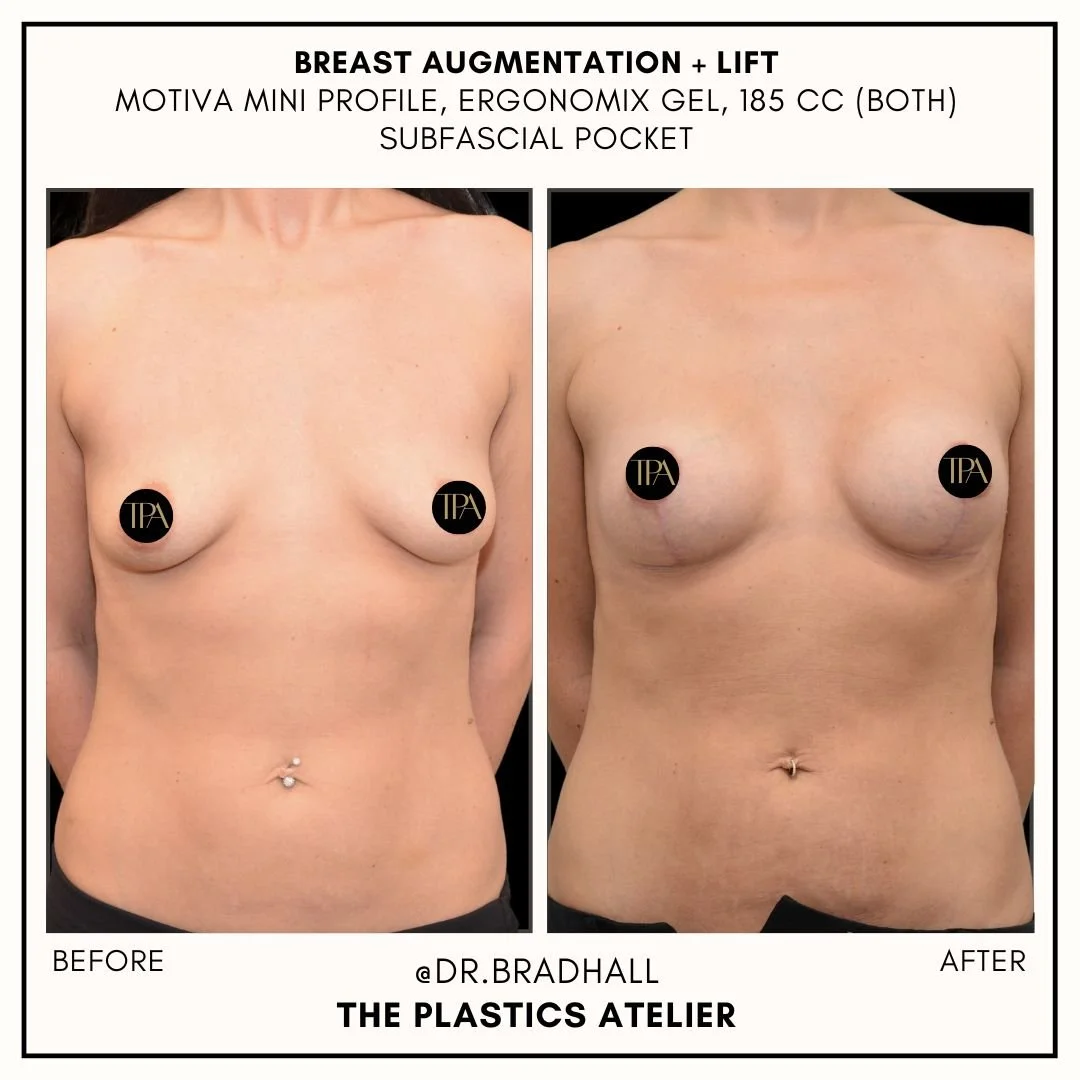 Side-by-side comparison of a woman before and after breast augmentation surgery, showing increased breast size and improved shape post-procedure.