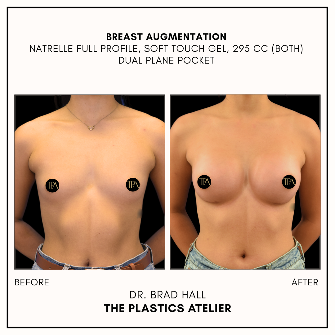Side-by-side before and after images of a woman showing breast augmentation results, with the left labeled 'BEFORE' and the right labeled 'AFTER'. The woman has a neutral background and is wearing minimal clothing. The text indicates the procedure wa